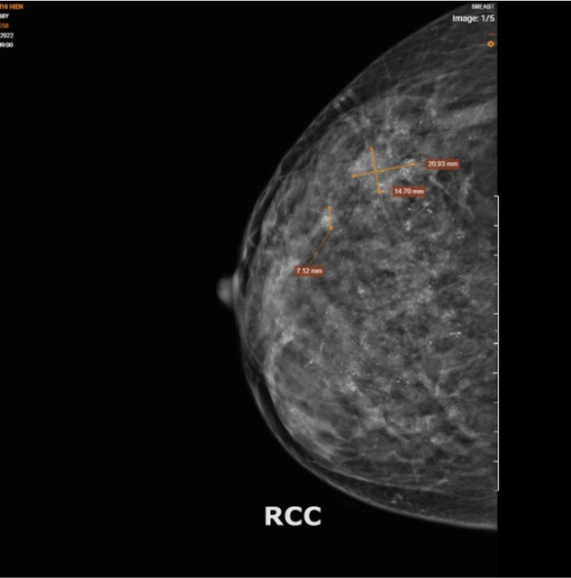  Hình ảnh chụp X-quang cho thấy hiện tượng vi vôi hóa lan tỏa tuyến vú phải