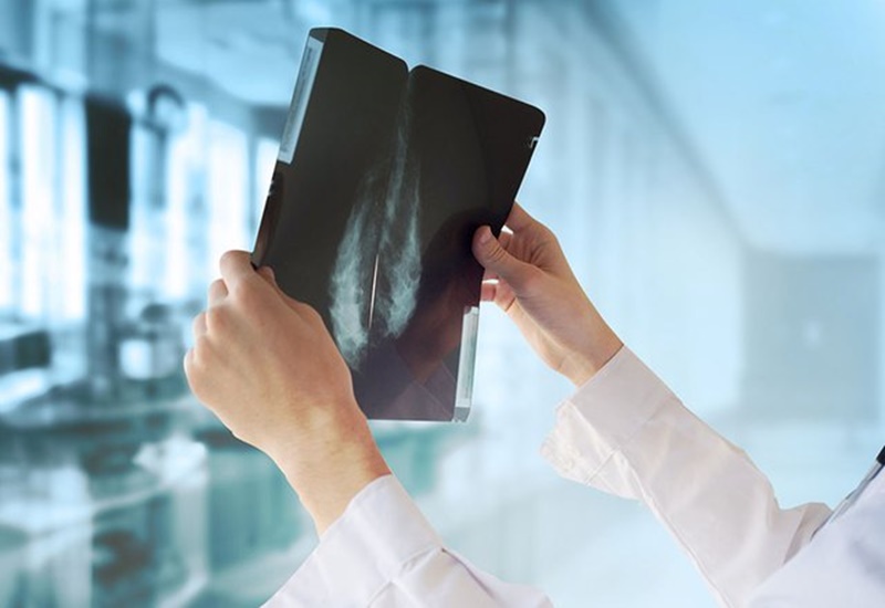 Chụp X-quang vú để nhận biết mức độ lan rộng của khối u