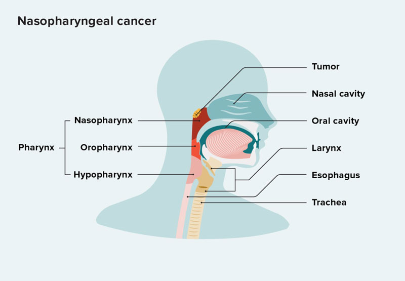 Đôi nét thông tin về bệnh ung thư ở hầu họng