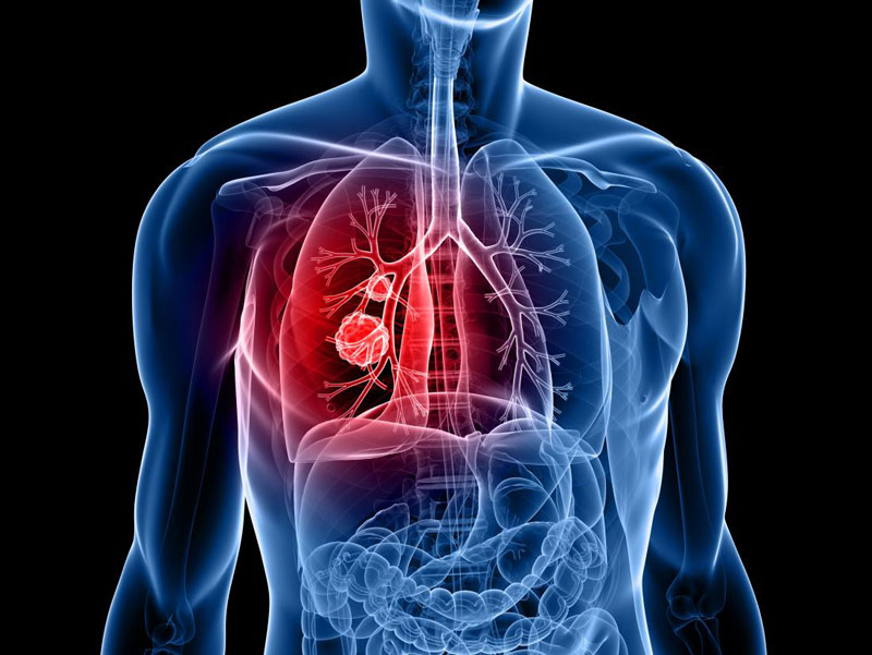 Ung thư phổi thường diễn biến nhanh và rất phức tạp