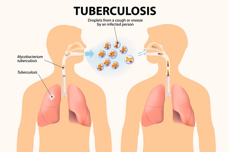 Bệnh lao phổi là một bệnh truyền nhiễm gây ra bởi vi khuẩn lao Mycobacterium tuberculosis