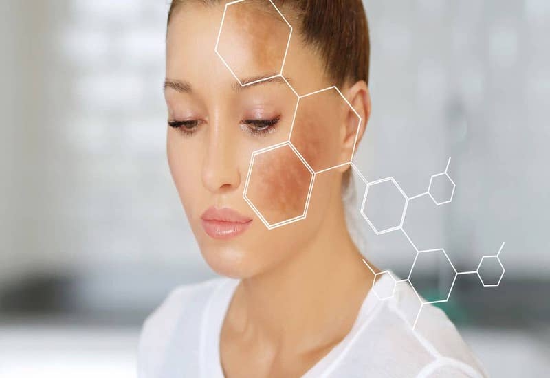 Nám da có thể xuất hiện ở nhiều vị trí da mặt và ở vùng da khác trên cơ thể