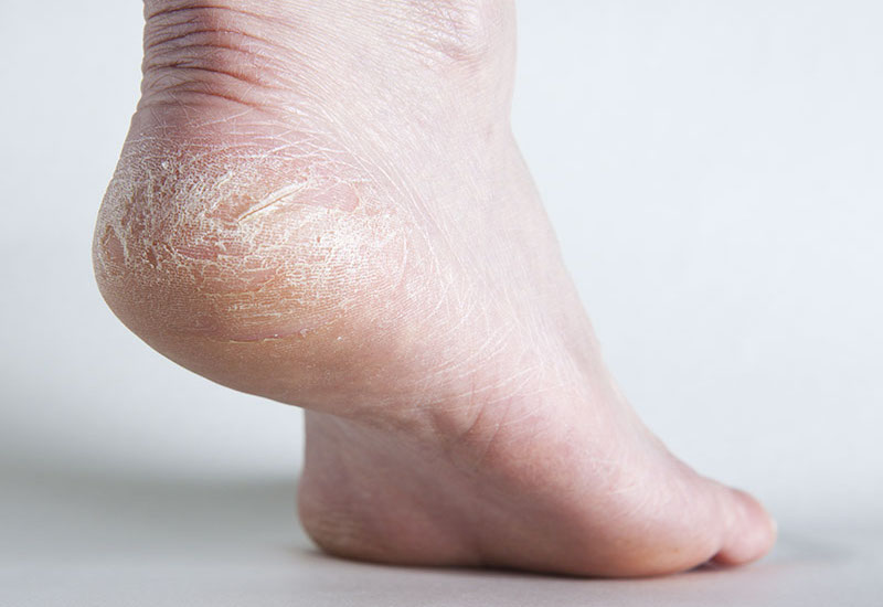 Nứt gót chân khiến vùng da ở gót chân trở nên khô, bong tróc, dày sừng và nứt nẻ