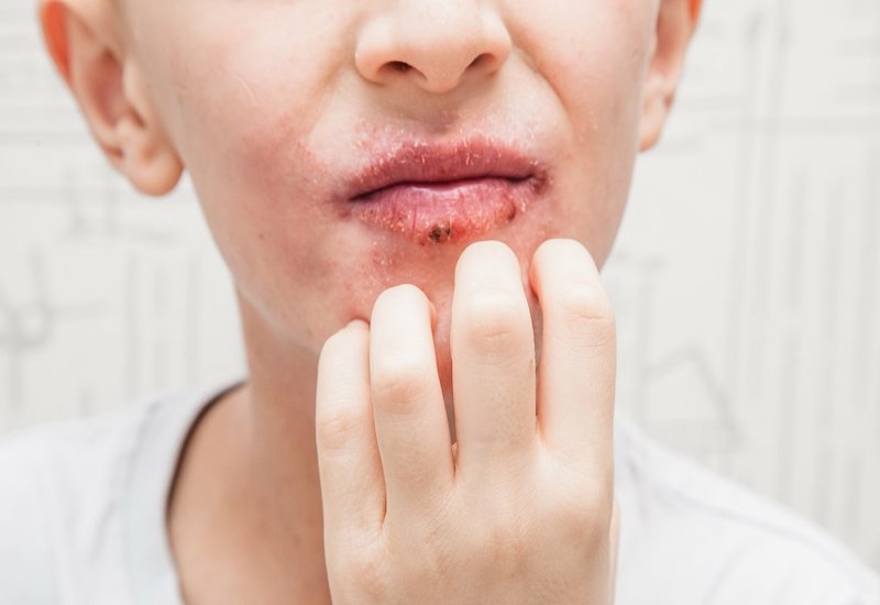 Viêm da quanh miệng khiến người bệnh đau đớn và khó chịu