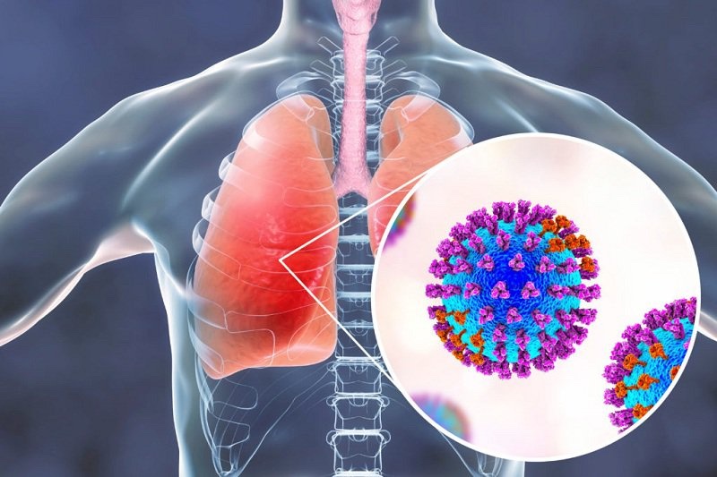 Bệnh viêm phổi thường gặp trong đời sống hiện nay