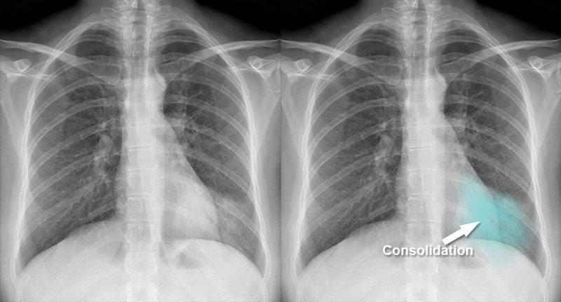 Bệnh nhân cần đi khám khi phát hiện dấu hiệu tổn thương phổi