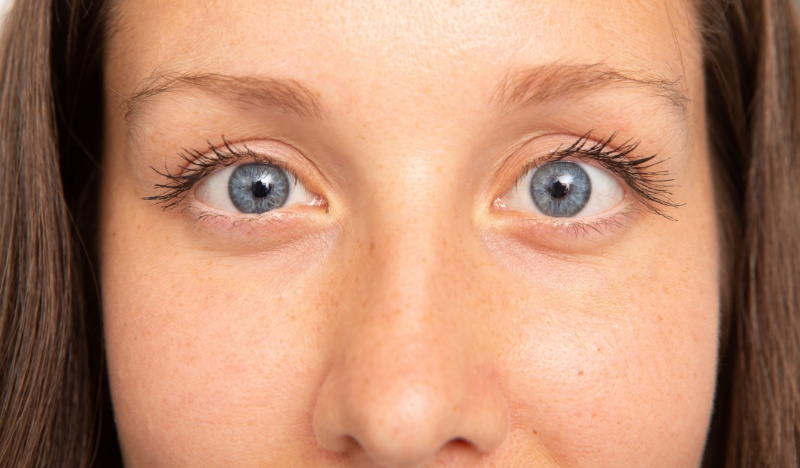 Một số yếu tố có thể làm tăng nguy cơ bị lác mắt