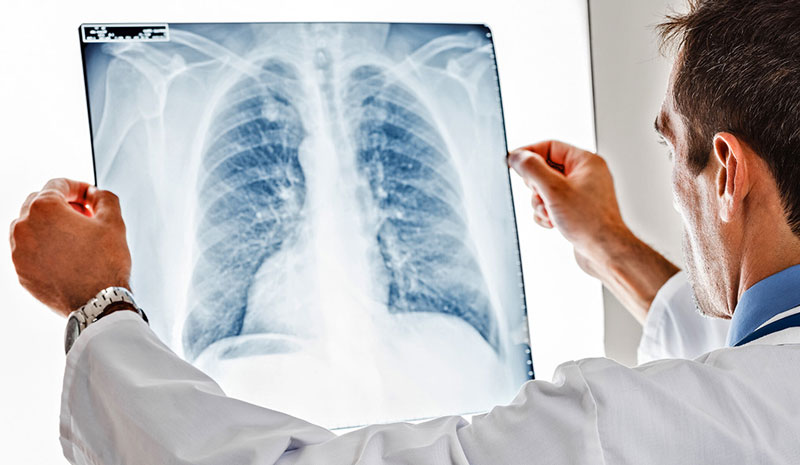 Ở giai đoạn toàn phát, phổi của bệnh nhân bị tổn thương nghiêm trọng