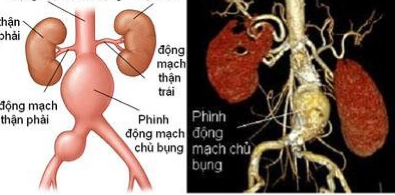 Hình ảnh mô tả về chứng phình động mạch chủ bụng
