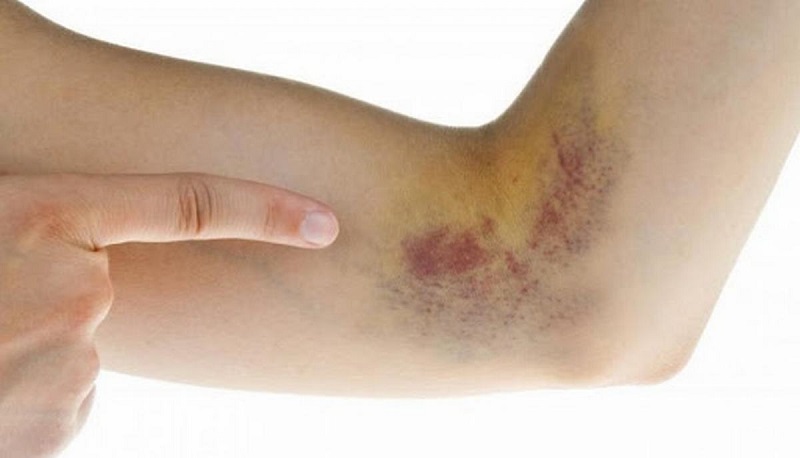Vỡ mạch máu dưới da tạo nên mảng xuất huyết màu tím đỏ