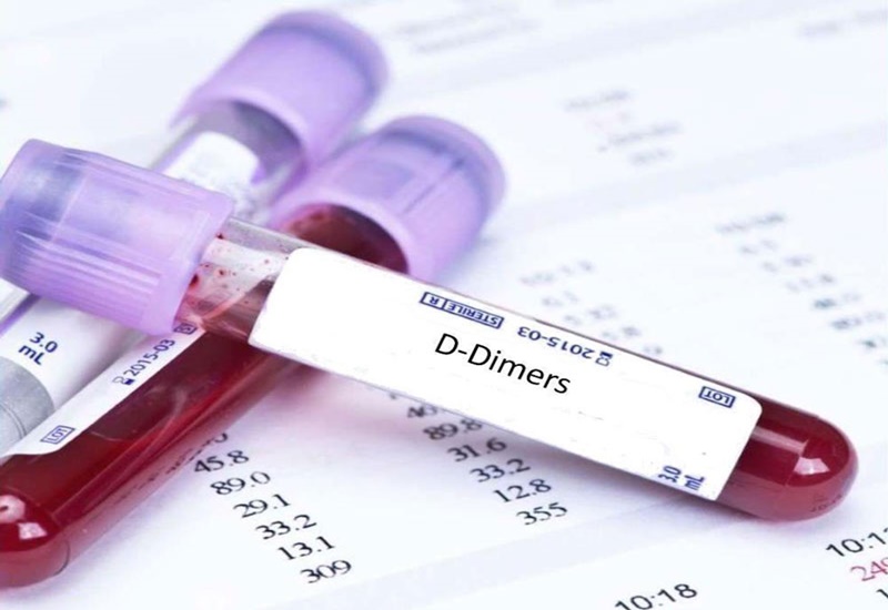 D-dimer là một đoạn protein nhỏ xuất hiện khi mạch máu hình thành các khối huyết