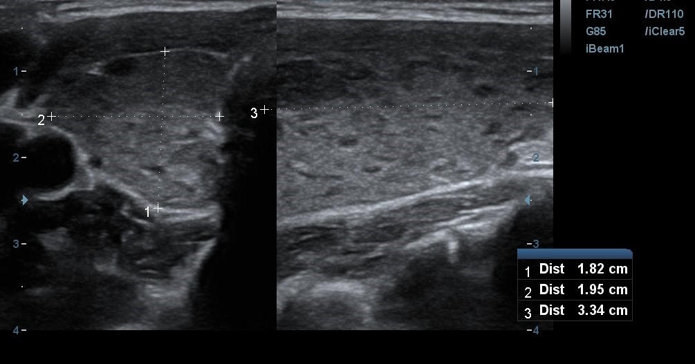 Hình ảnh siêu âm tuyến giáp trong bệnh Hashimoto