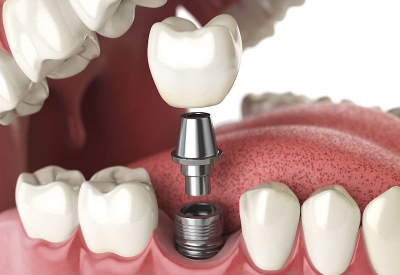 Trồng răng Implant giúp thay thế răng đã mất hoặc hư hại với công dụng không kém gì răng thật