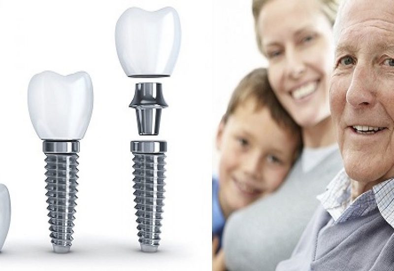 Tuổi thọ của những chiếc răng Implant có thể kéo dài rất lâu nếu được chăm sóc đúng cách