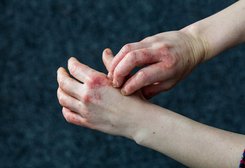 Viêm da bàn tay nếu không được điều trị sẽ dẫn tới những biến chứng nguy hiểm