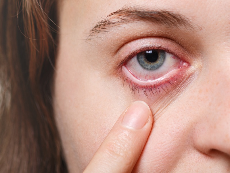 Hội chứng khô mắt