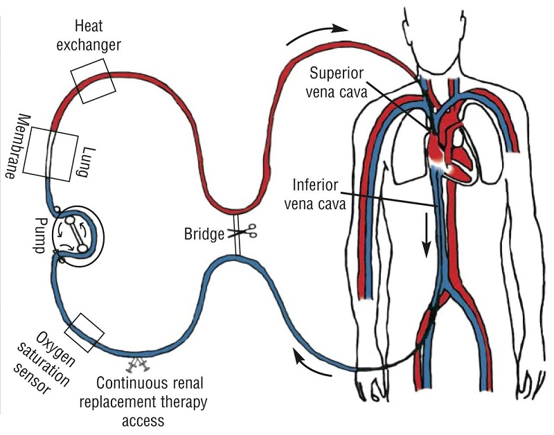 ECMO là một hệ thống máy tim phổi nhân tạo thay thế cho hoạt động của tim phổi