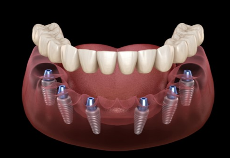 Trồng implant toàn hàm giúp phòng ngừa những biến chứng do mất răng gây ra