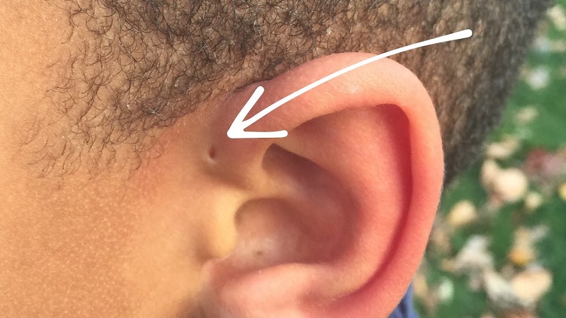 Vị trí thường gặp của lỗ rò luân nhĩ trên tai