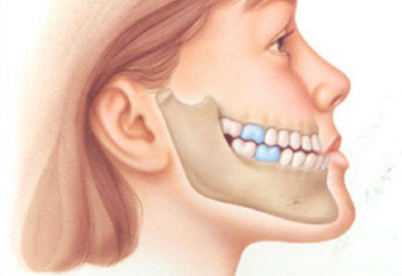 Răng móm gây ảnh hưởng đến chức năng nhai