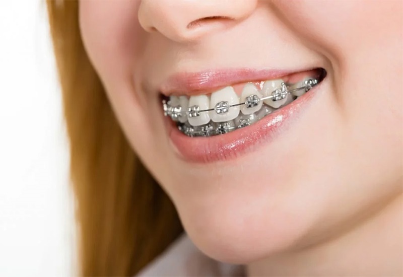 Sau mỗi lần chịu lực kéo thì răng của người bệnh sẽ ổn định hơn