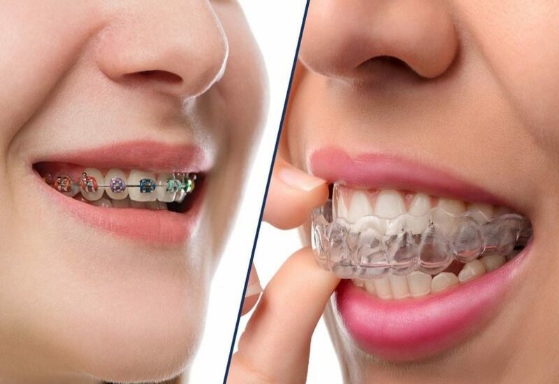 Niềng răng trong suốt đảm bảo tính thẩm mỹ hơn so với niềng răng mắc cài kim loại