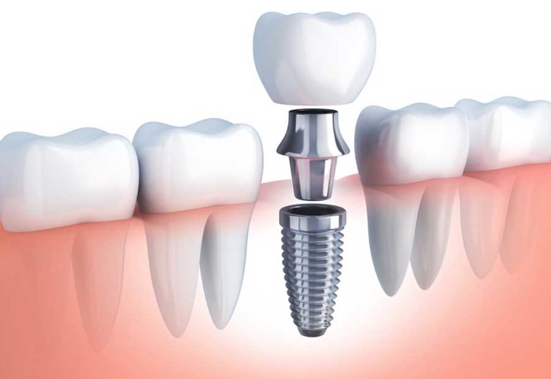 Trụ Implant có thể nhanh chóng tích hợp với xương hàm