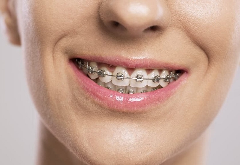 Niềng răng giúp bạn sở hữu hàm răng đều đẹp hơn
