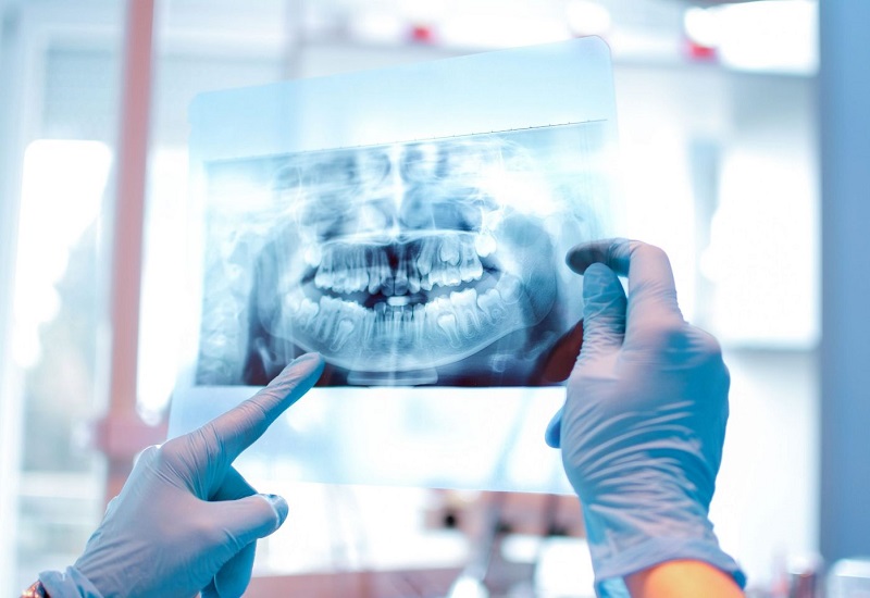 Khi đưa ra chỉ định nhổ răng Bác sĩ sẽ thăm khám và dựa trên kết quả chụp X-quang