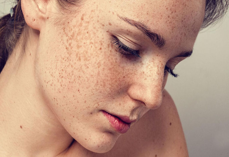 Nám da là tập hợp các đốm màu nâu nhạt, nâu đậm hay những mảng sắc tố lớn trên da