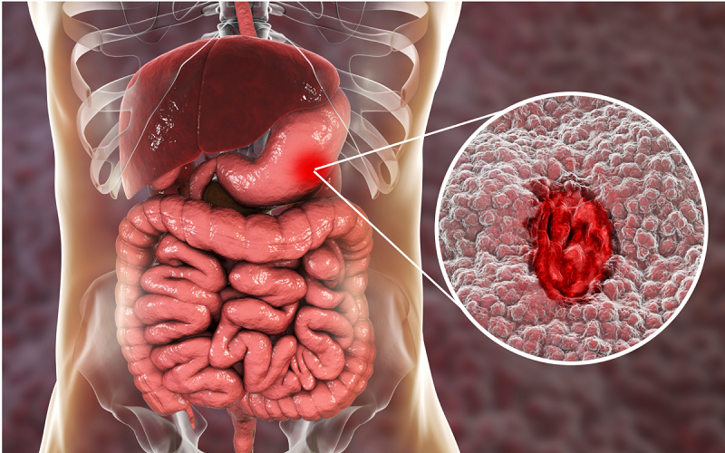 Ung thư dạ dày xảy ra khi có sự phát triển bất thường mất kiểm soát của các tế bào trong dạ dày