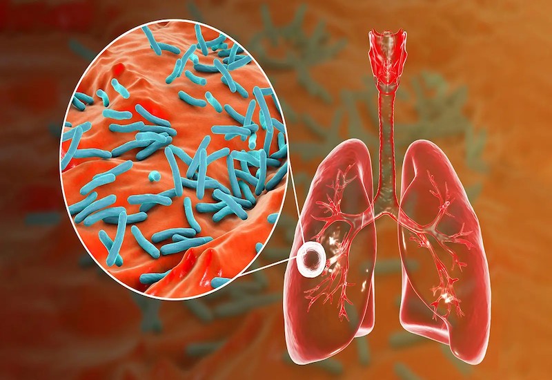Lao phổi là do vi khuẩn lao thuộc họ Mycobacterium gây nên