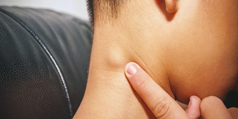 Nổi hạch ở vùng cổ là triệu chứng đặc trưng của ung thư vòm họng