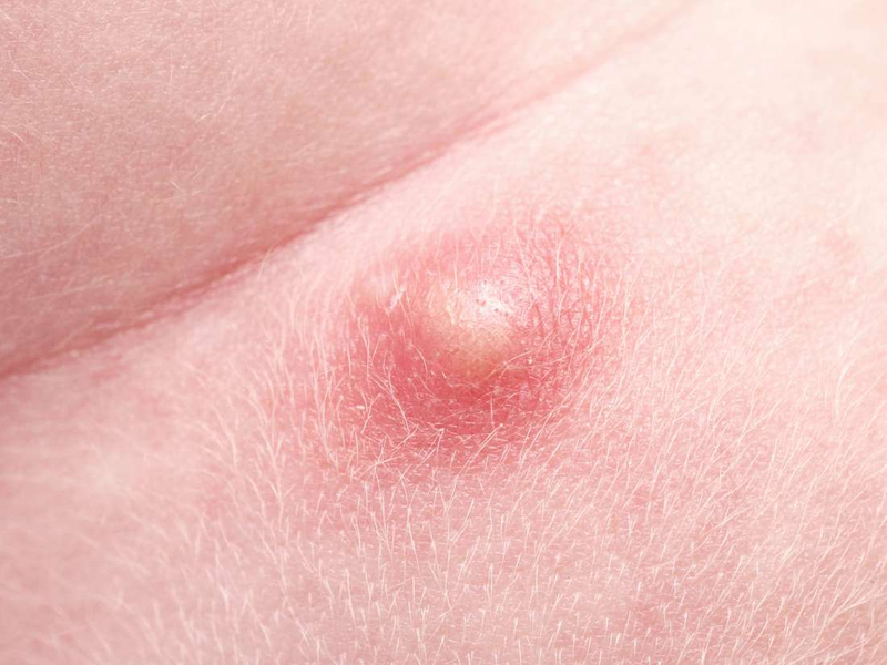Những người mắc các bệnh lý về da dễ gặp phải tình trạng mọc mụn ở mông