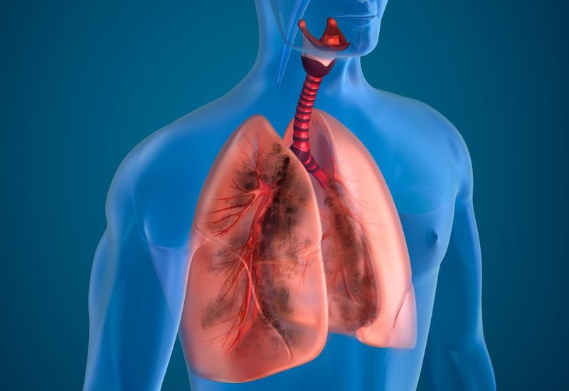 Nắm rõ thông tin của các bệnh về phổi  sẽ giúp ta phòng tránh các bệnh lý này tốt hơn