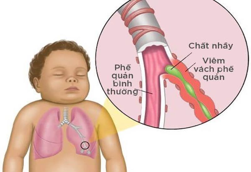 Phế quản bình thường và phế quản ở trẻ bị hen suyễn