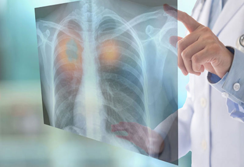 U phổi lành tính là khi có một khối u xuất hiện tại phổi hoặc trong đường hô hấp đi tới phổi