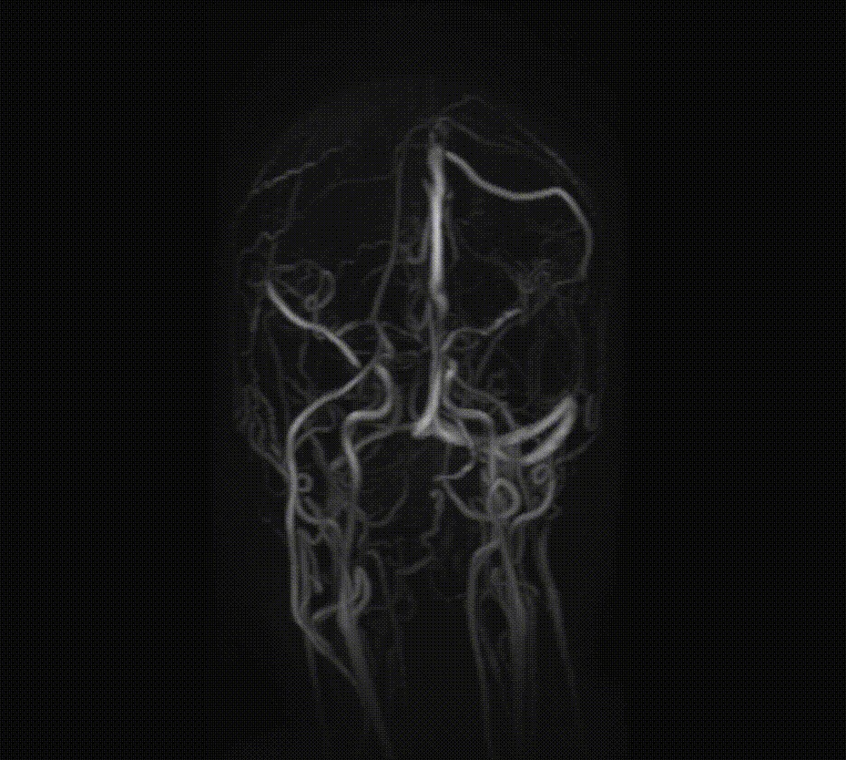Hình ảnh 3D chụp MRI tĩnh mạch sọ không tiêm thuốc (MRV) tại BVĐK MEDLATEC cơ sở 99 Trích Sài -Tây Hồ