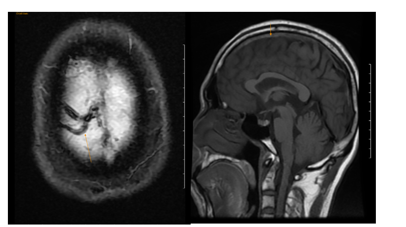 Hình ảnh huyết khối Tĩnh mạch não chụp MRI tại BVĐK MEDLATEC