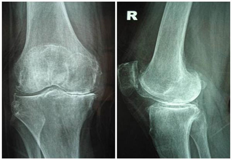 Chụp X-quang để phát hiện sớm những bệnh lý về xương khớp