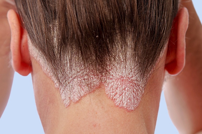 Bệnh vảy nến da đầu gây mất mỹ quan khiến người bệnh tự ti