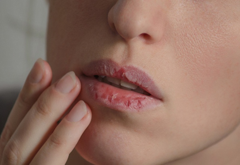Bị khô, ửng đỏ, nứt nẻ môi là một triệu chứng của bệnh 