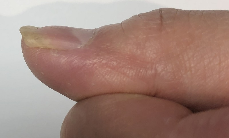 Tình trạng lõm móng tay bất thường có thể là triệu chứng cảnh báo bệnh lý 