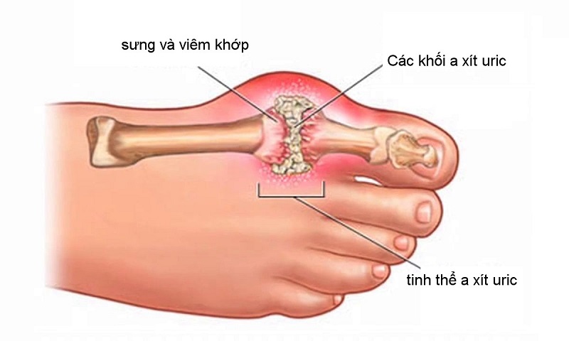 Tăng acid uric máu là nguyên nhân chính gây ra bệnh gout