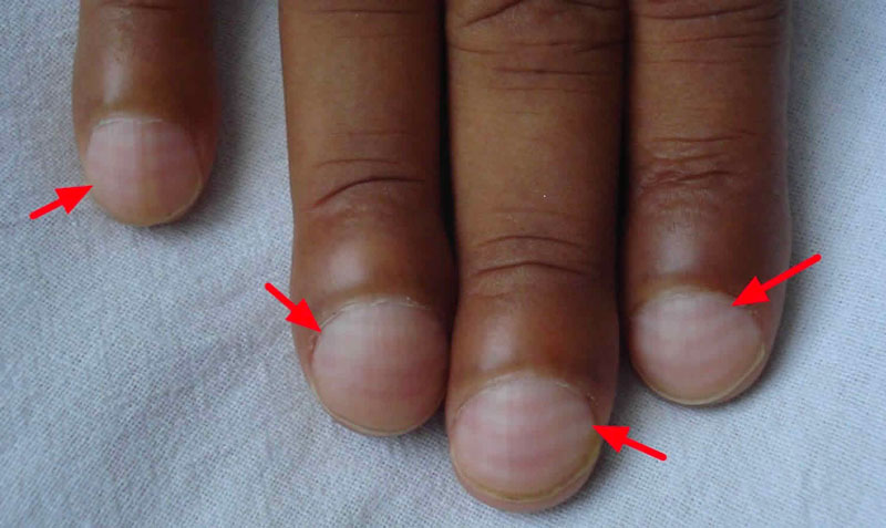 Người có ngón tay dùi trống thì phần móng tay sẽ có kích thước lớn hơn so với người bình thường