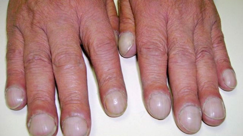 Một số bệnh lý có thể là nguyên nhân khiến ngón tay dùi trống xuất hiện