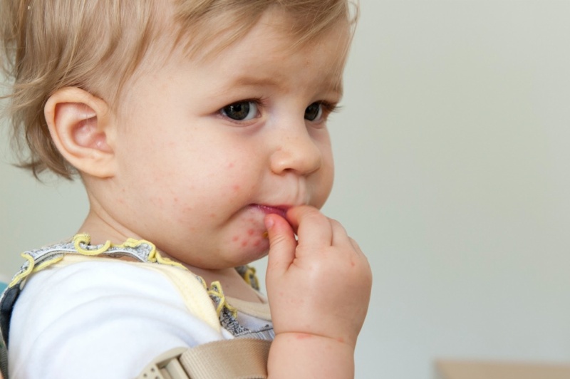 Bệnh tay chân miệng có thể làm vùng da quanh miệng trẻ bị mẩn đỏ