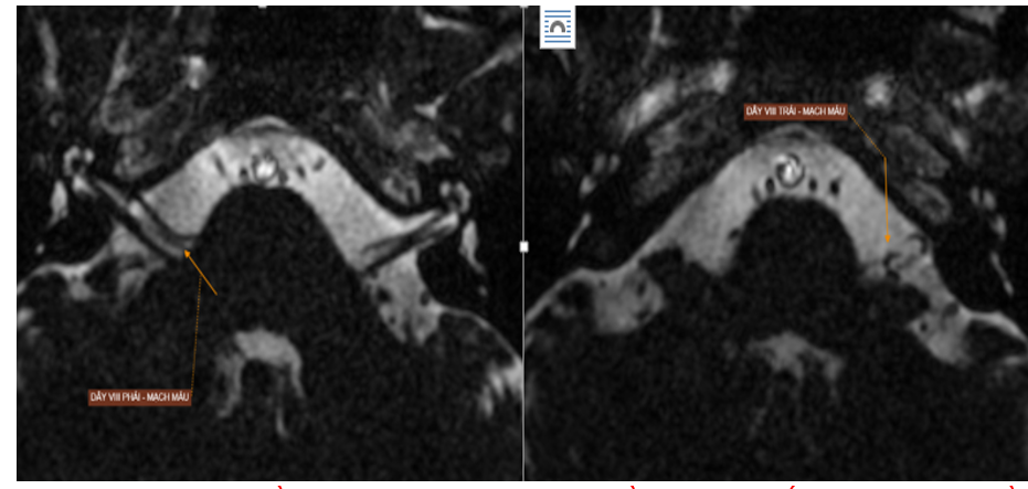 Hình ảnh theo dõi xung đột thần kinh - mạch máu dây thần kinh sọ số VIII hai bên (thần kinh tiền đình - ốc tai)