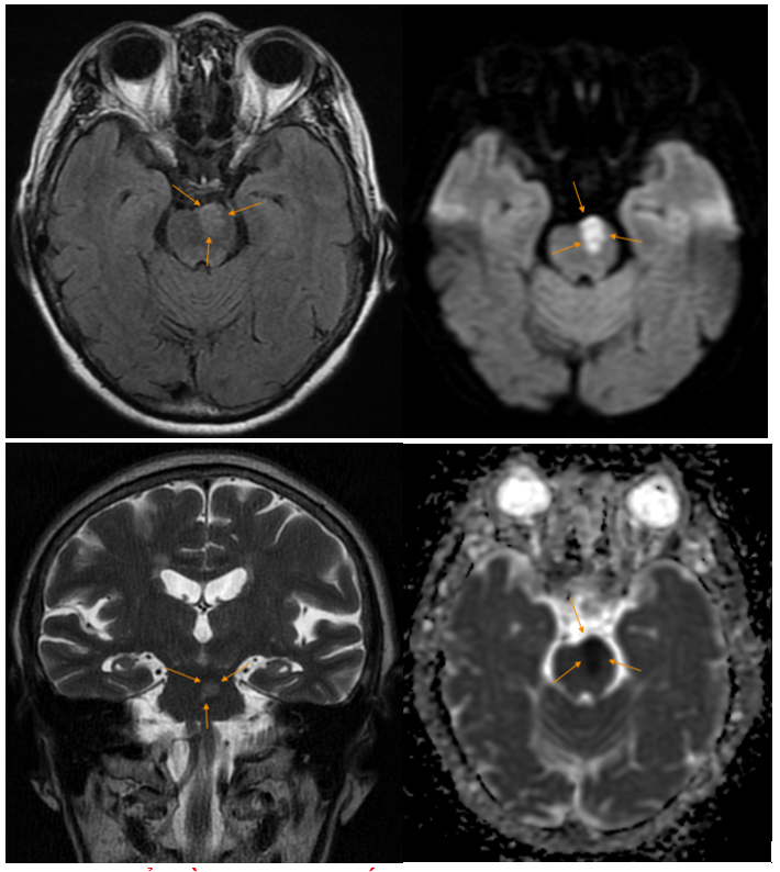 Hình ảnh ổ nhồi máu não bán cấp của một bệnh nhân tại MEDLATEC