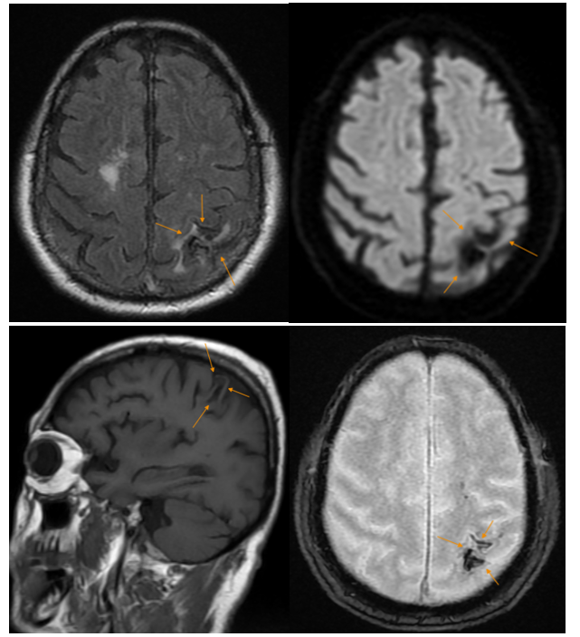 Hình ảnh ổ xuất huyết não giai đoạn bán cấp muộn của một bệnh nhân tại MEDLATEC